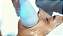 Criusculpt 4 Slim Criolipólise Ultrassom De Baixa Frequência - Htm - Imagem 7