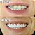 Sorriso Perfeito Com Smile Dentes Postiço - Imagem 3