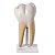 Dente Molar Ampliado Saudável e com Cárie - TGD-0311-B - Imagem 1