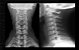 RX da Coluna Cervical - AP/PERFIL - Imagem 1