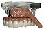 Manequim Odontológico Protocolo Superior 6 Implantes - Imagem 1
