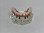 Manequins Modelos Odontológicos Protocolo 6 Implantes e Overdenture Barra Clipe 2 Implantes - Imagem 4