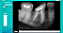Sensor Digital T2 Intraoral Slim Saevo - Imagem 3