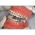 Aparelho Twin Force Bite Corrector - Tratamento da Classe II e III - Ortho Organizers - Imagem 3