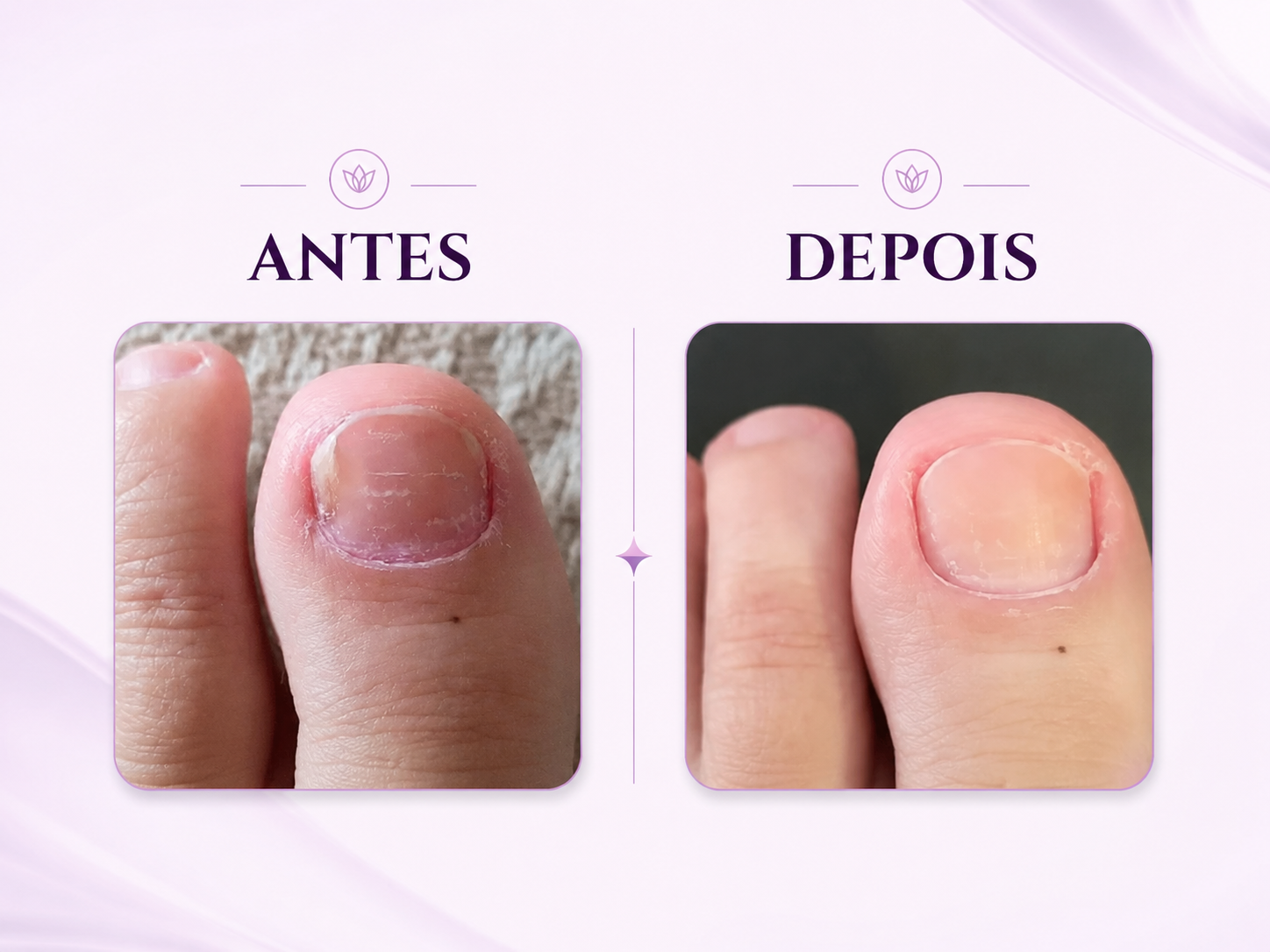 Comparativo ilustrativo de unha antes e depois