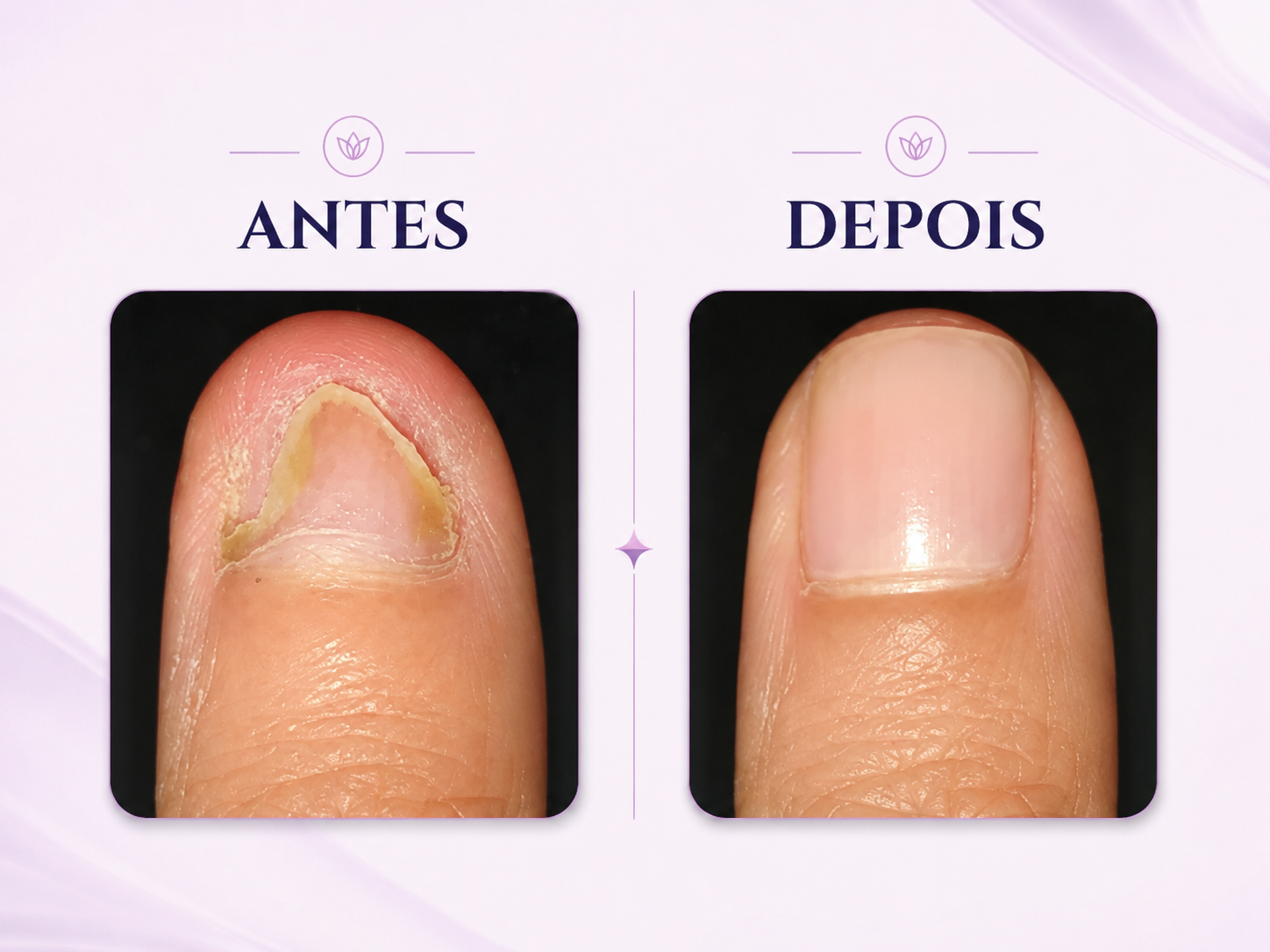 Comparativo ilustrativo de unha antes e depois