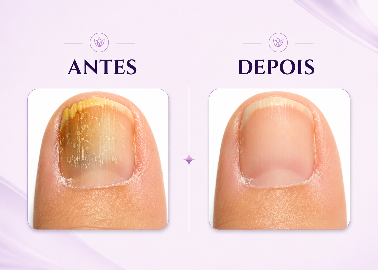 Comparativo ilustrativo de unha antes e depois