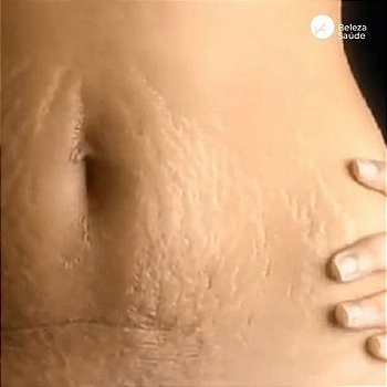 Estrias Pós Parto : Loção Cremosa Reduz Trata - 150g