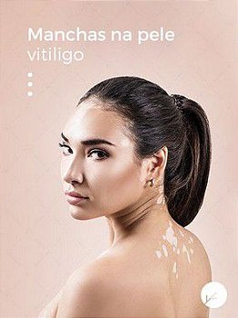 Pigmerise 20% Tratamento de Vitiligo e Manchas - 30g