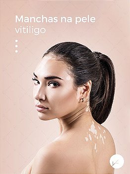 Pigmerise 20% Tratamento de Vitiligo e Manchas