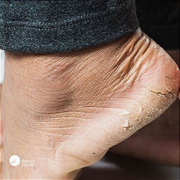 Uréia + Óleo de Silicone + 2 Ativos - Creme p/ Pés Rachados