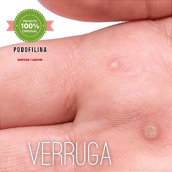 Podofilina 25% Tratamento Anti Verrugas