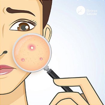 Composto Probiótico + Vitaminas - Tratamento Da Acne