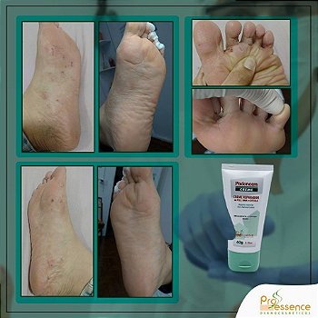 Podoneem Creme 60gr - Creme Reparador da Pele, Unhas e Cutícula das Mãos e Pés