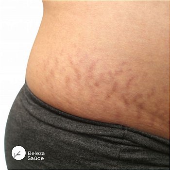 Creme para Estrias Vermelhas : Redutor das Marcas, Regenera a Pele