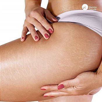 Estrias Brancas Mulher + 40 Anos : Loção Reduz Trata
