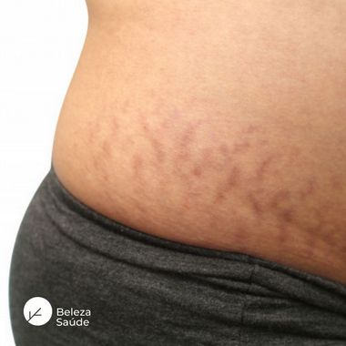 Creme para Estrias Vermelhas : Redutor das Marcas, Regenera a Pele - 100g