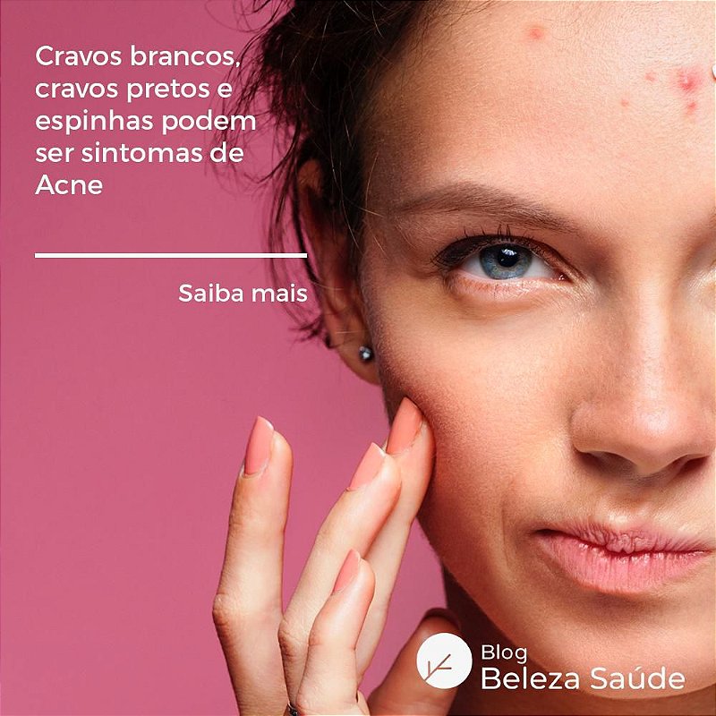 Ácido Glicólico 10% Tratamento da Acne
