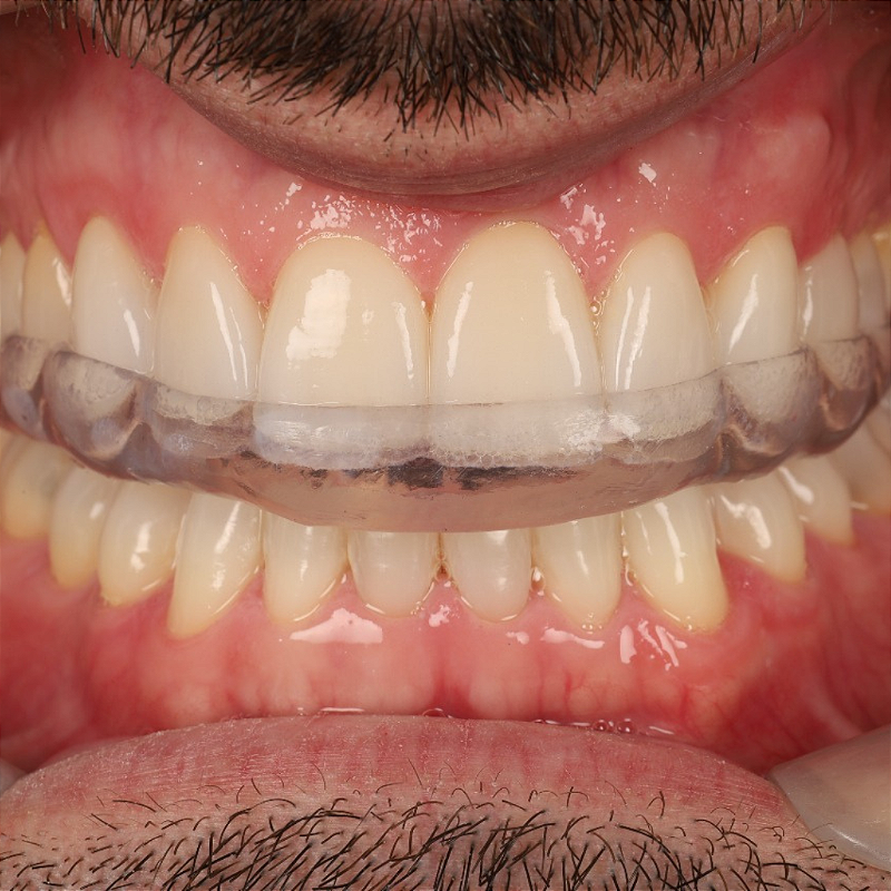 Resina 3d Smart Print Bio Bite Splint Flex 04 Ayrwlli478