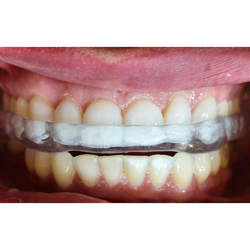 Resina 3d Smart Print Bio Bite Splint Flex 05 Xdlxh1u1c1