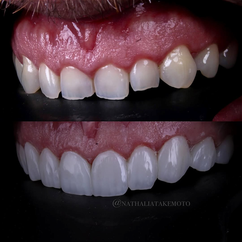 Atos Resina Composta Direta 06 5krfjd4lyk