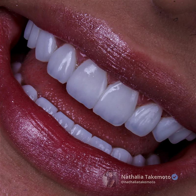 Atos Resina Composta Direta 05 1v9zmgrpvj