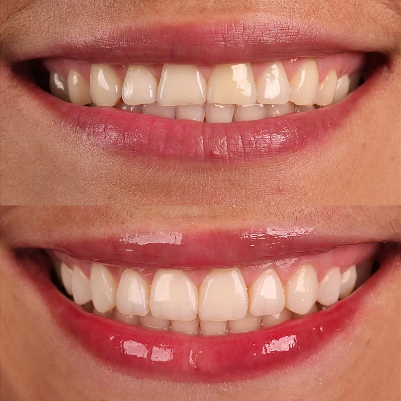 Atos Resina Composta Direta 11 45ier8t25v