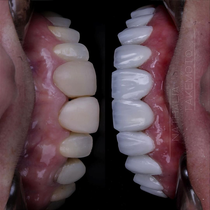 Atos Resina Composta Direta 02 4p7jweohzz