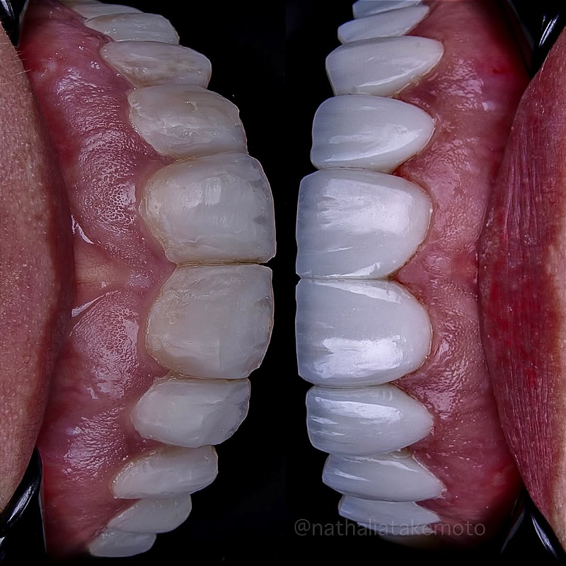 Atos Resina Composta Direta 04 0m942hgi68