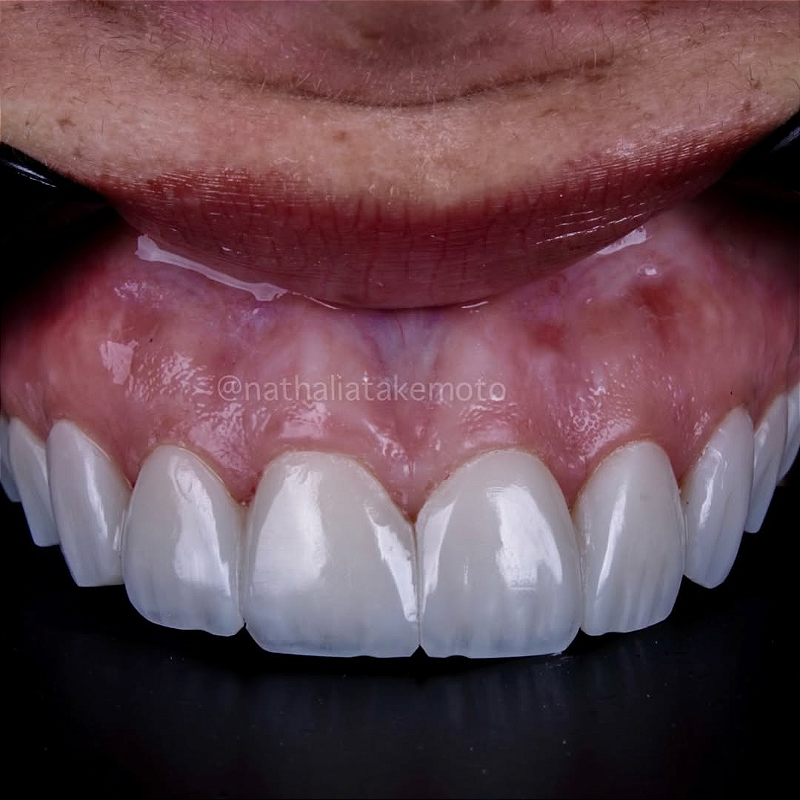 Atos Resina Composta Direta 08 9vkse4s57m