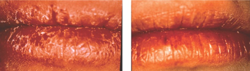 Lábios antes e após uso
